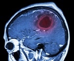 NovoSeven may prove to be the first effective treatment for brain hemorrhage caused by stroke