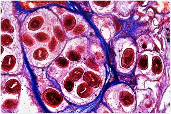 Echinococcus granulosus - Hydatid worm in liver. Image Copyright: D. Kucharski K. Kucharska / Shutterstock