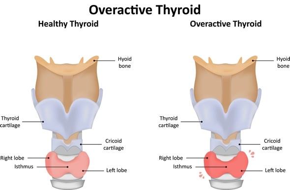 Overactive Thyroid - Image Copyright: joshya / Shutterstock