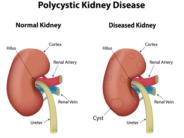 Poly cystic Kidney Disease - Image Copyright: joshya / Shutterstock