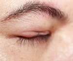What Causes a Stye?