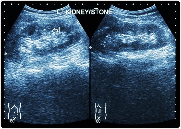 Ultrasonography of kidney : show left kidney stone ( 2 image for compare ), Image Copyright: Puwadol Jaturawutthichai / Shutterstock