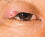 Stye / Hordeolum - Painful Lumps on Eyelids