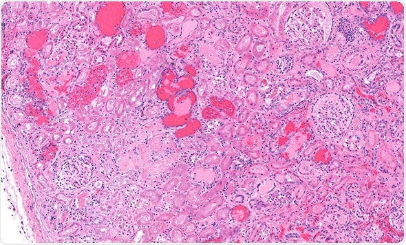 Kidney from a case of hemolytic uremic syndrome due to E. Coli. Nephritis due to E Coli. Hemolytic uremia. Image Copyright: vetpathologist / Shutterstock