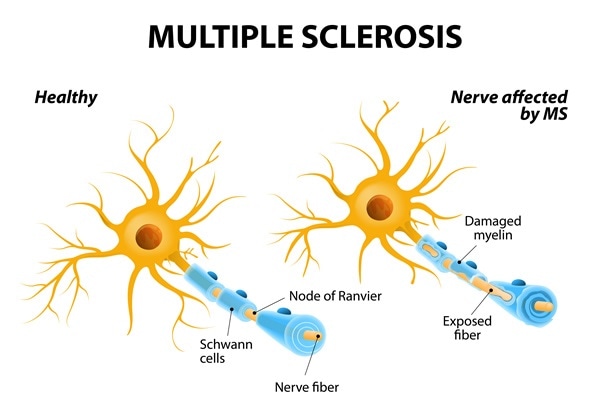 Types of Multiple Sclerosis (MS)