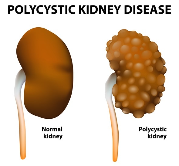 Polycystic kidney disease. Normal and polycystic kidneys - Image Copyright: Designua / Shutterstock