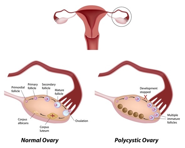 Normal ovarian cycle and Polycystic ovary syndrome - Image Copyright: Alila Medical Media / Shutterstock