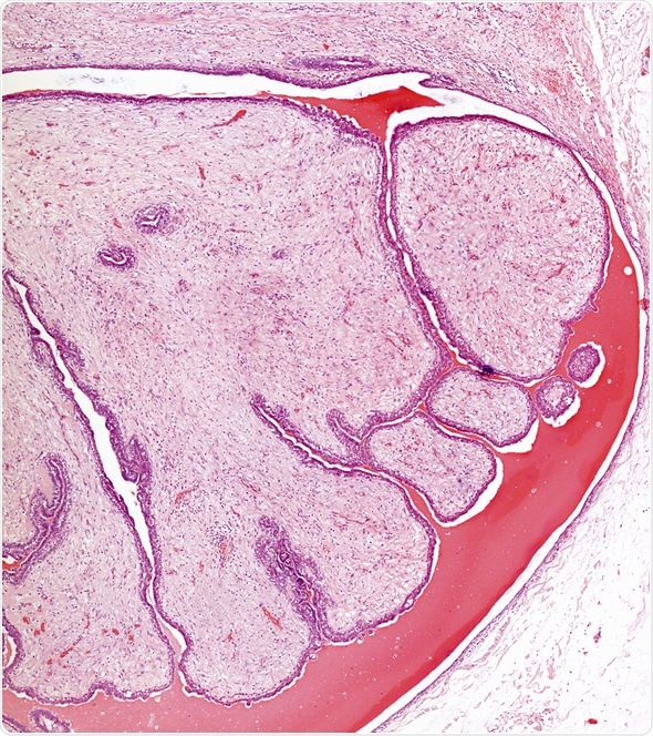 Microscope picture of fibroadenoma of the breast - Image Copyright: Convit / Shutterstock