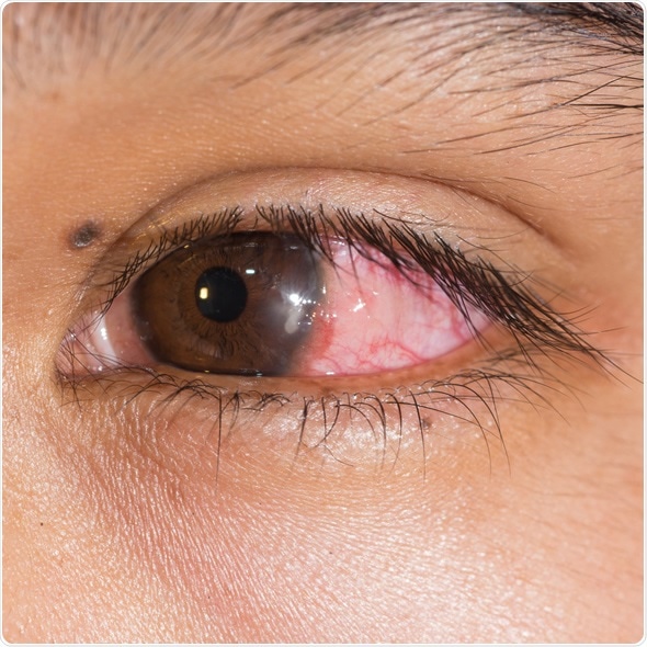Close up of the infected bacterial corneal ulcer during eye examination. Image Copyright: ARZTSAMUI / Shutterstock