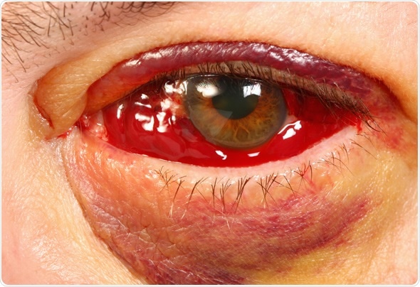 Bloody Eye 1 1/2 weeks after vitrectomy surgery for PVR (retinal detachment). Image Copyright: Steve Bower / Shutterstock