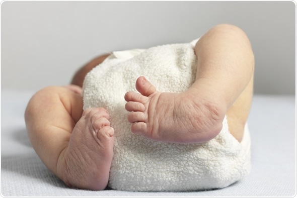 Recém-nascido com o pé de clube bilateral, igualmente chamado imagem congenital Copyright do equinovarus dos talipes: Alis Leonte/Shutterstock