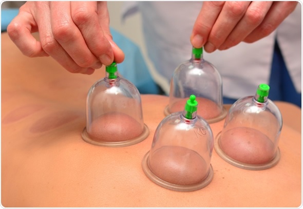 Cupping therapy - Image Copyright: Kavun Halyna / Shutterstock