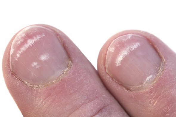 Fingernails closeup with the condition called leukonychia, white lines under the nail. Image Copyright: deepspacedave / Shutterstock