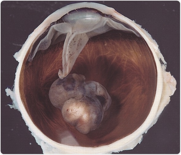 Variably pigmented, mushroom-shaped choroidal tumor has ruptured the Bruch membrane and grown into the subretinal space. Image Credit: The Armed Forces Institute of Pathology (AFIP) - PEIR Digital Library (Pathology image database). Image# 406734.