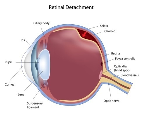 Eye condition: retinal detachment - Image Copyright: Alila Medical Media / Shutterstock