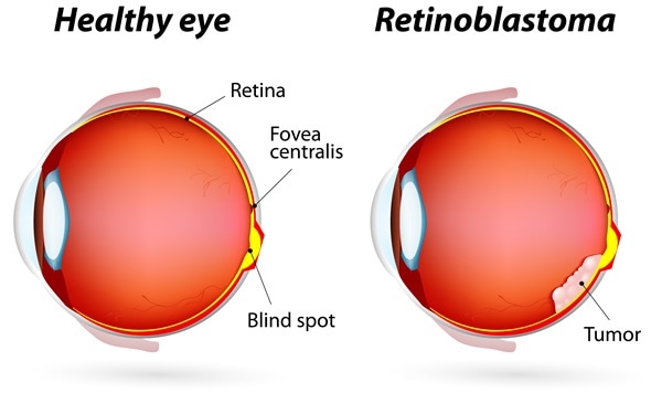 Eye disease. Healthy eye and Retinoblastoma. Image Copyright: Designua / Shutterstock