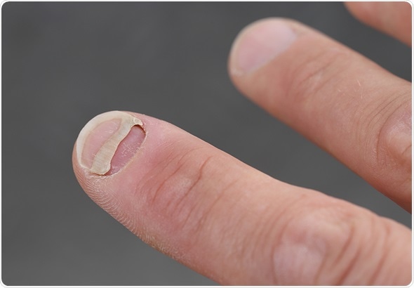 A Patient with nail detachment - Image Copyright: riopatuca via Shutterstock