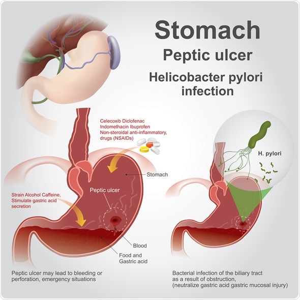 Peptic ulcer disease, also known as a peptic ulcer, is a break in the lining of the stomach - Image Copyright: Artwork studio BKK / Shutterstock