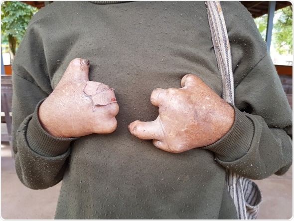 Closeup hands of asian old man suffering from leprosy, Thailand - Image Credit: Bidarat Tiemjai / Shutterstock