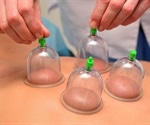 New review examines effectiveness of cupping therapy in athletes