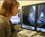 Link between breast cancer risk factor and inflammation raises hopes for preventative treatments