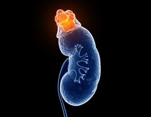 New clinical study tests effectiveness of water to treat polycystic kidney disease