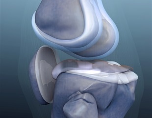 Rehabilitation for chronic knee pain may not be targeting all the right muscles