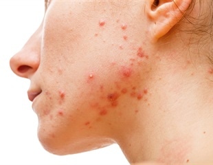 Acne and diet: an interview with Dr Katerina Steventon, Research Fellow, HONEI, University of Hull