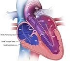 Pulmonary Atresia - Congenital Heart Defect