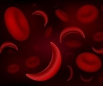 Study: Lower blood oxygen levels can lead to heart abnormalities in children with sickle cell disease