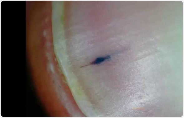 Nail Splinter Hemorrhage - Image Credit: Microscope Adventure / YouTube