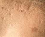 PDT-PCI combination with ENVIRON Surgical Roll-CIT effective for treating facial acne scars