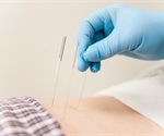 Acupuncture just as effective without needle penetration