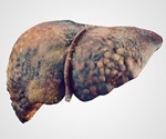 New hope for millions of patients suffering from liver damage (cirrhosis)