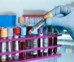 Breakthrough blood test developed for early detection of sarcoidosis