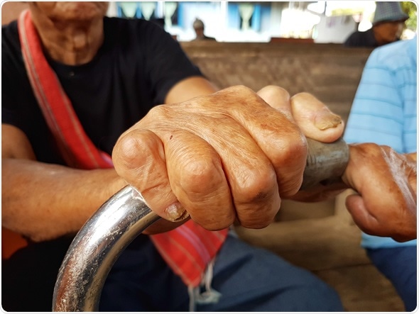 Closeup hands of asian old man suffering from leprosy, Thailand - Image Credit: Tidarat Tiemjai / Shutterstock