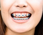 New six month braces system straightens adult front teeth with lower cost, less discomfort