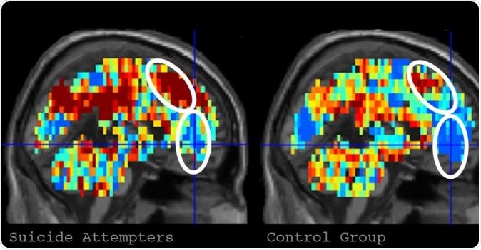 On the left is the brain activation pattern for