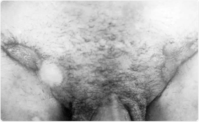 A photograph of granuloma inguinale identified through differential diagnostic technique. The differential diagnosis proved to be that of granuloma inguinale and not Syphilis. Granuloma inguinale, caused by Calymmatobacterium granulomatis, results in surface destruction and granuloma formation of the skin and subcutaneous tissue. Image Credit: CDC/Susan Lindsley