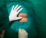 Robotically assisted minimally invasive bladder reconstructive surgery on children performed