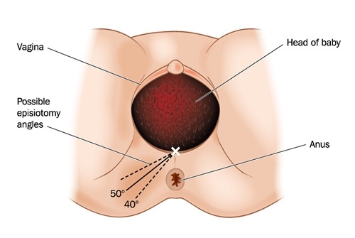 Drawing of possible episiotomy angles performed during childbirth. Image Credit: Blamb / Shutterstock
