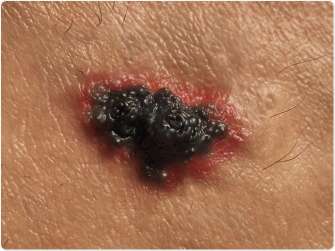 Malignant  melanoma. Image Credit: Juan Gaertner / Shutterstock