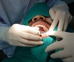 Recovery After Root Canal Treatment