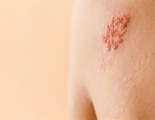CDC recommends new vaccine for shingles