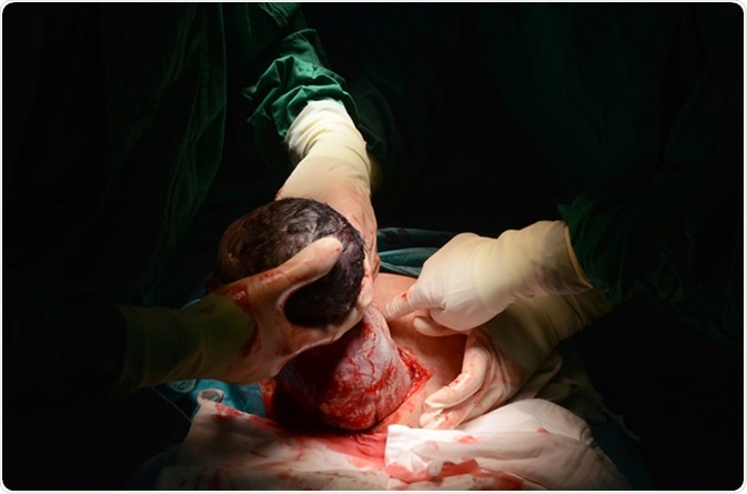 New baby being born during cesarean section. Image Credit: Chattapat / Shutterstock