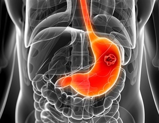 Bacteria commonly found in the body play a significant role in causing stomach cancer