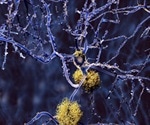 Study finds link between increased brain glucose levels and Alzheimer's