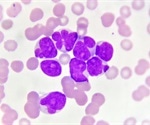 Case report and review of a novel chromosomal abnormality in AML patient