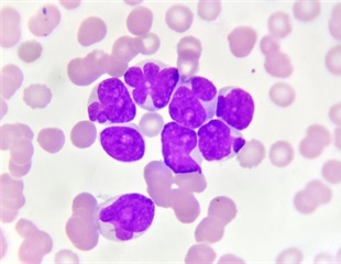 Case report and review of a novel chromosomal abnormality in AML patient