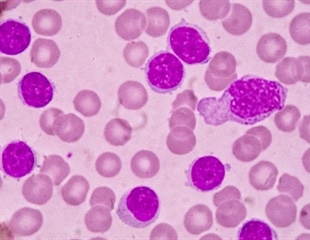 Patients with high-risk chronic lymphocytic leukemia may benefit from treatment with ibrutinib plus venetoclax